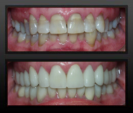 closeup of a female's smile before and after a full mouth restoration