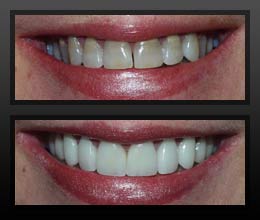 closeup of a female's smile before and after a full mouth reconstruction