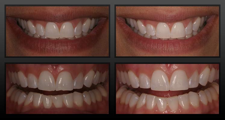 Patient43 - Rochester Advanced Dentistry tooth bonding in rochester mi