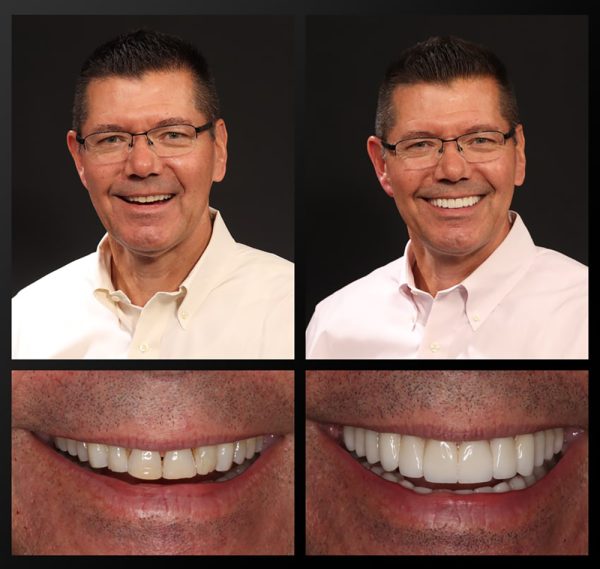 Haddad Patient Before and After Dennis