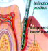Advanced Periodontitis
