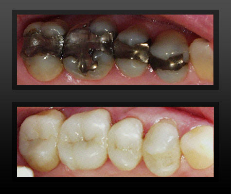 Tooth Colored Fillings in Rochester, MI