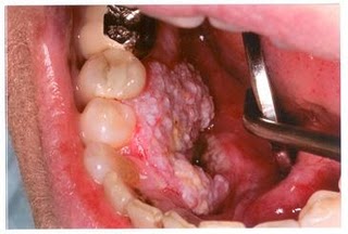 Oral Cancer
