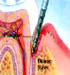 Periodontitis