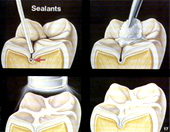 Sealants
