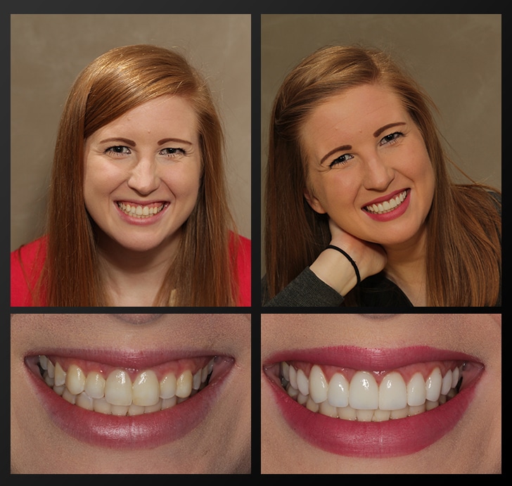 Erica's portrait and smile close up before and after dental treatment