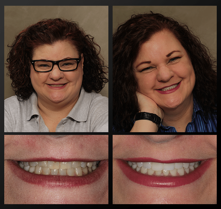 Tammy - Dentist Patient Before & After