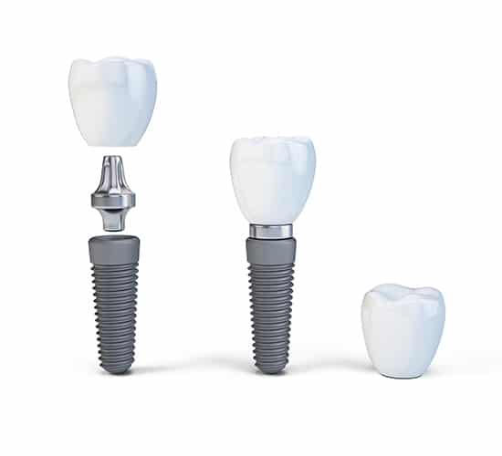 DentalImplantAnatomy Dental Implant Examples
