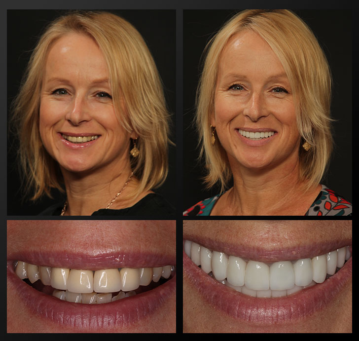Mary Ann - Patient Before & After - Rochester Advanced Dentistry Barb - Patient Before & After