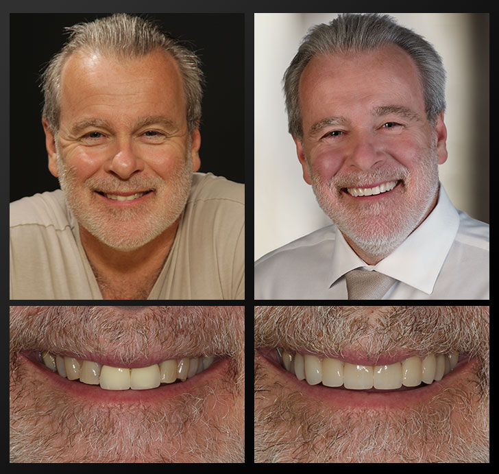 Mary Ann - Patient Before & After - Rochester Advanced Dentistry Hans - Patient Before & After