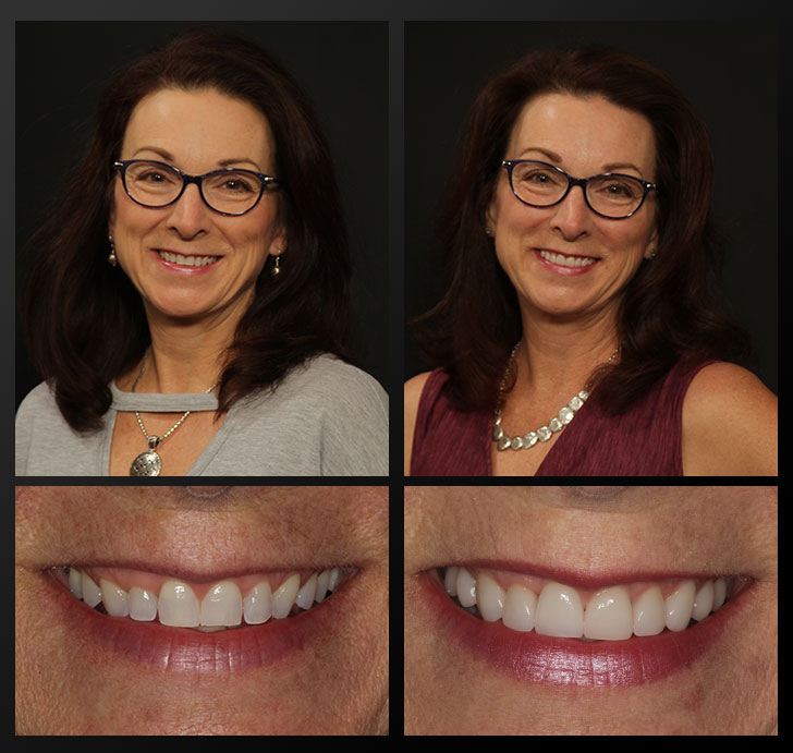 Mary Ann - Patient Before & After - Rochester Advanced Dentistry Sheri - Patient Before & After