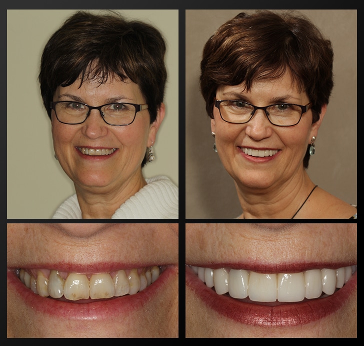 Cindy's portrait and smile close up before and after dental treatment fixes discoloration, receding gums, and uneven teeth