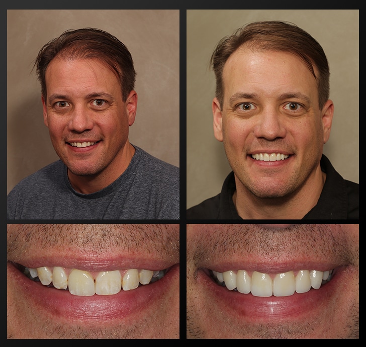 Larry's portrait and smile close up before and after dental treatment fixes gaps