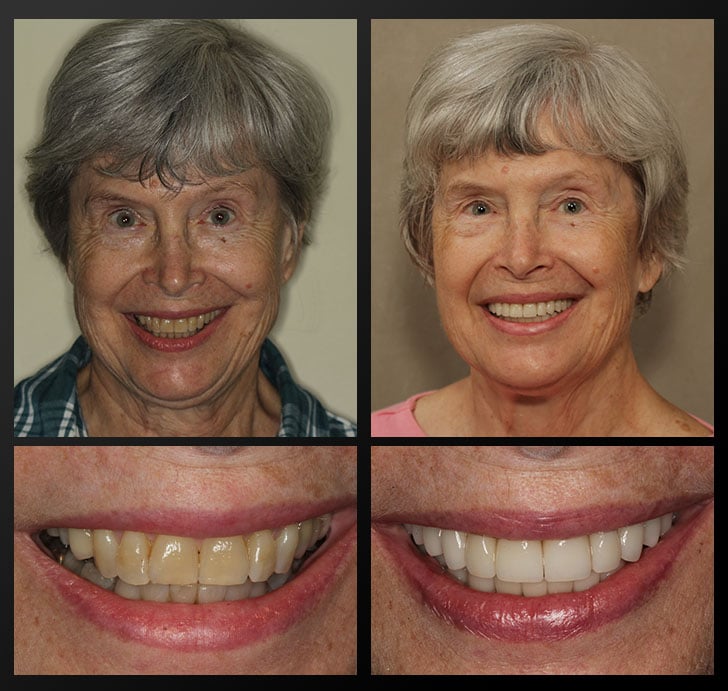Mary's portrait and smile close up before and after dental treatment fixes discoloration
