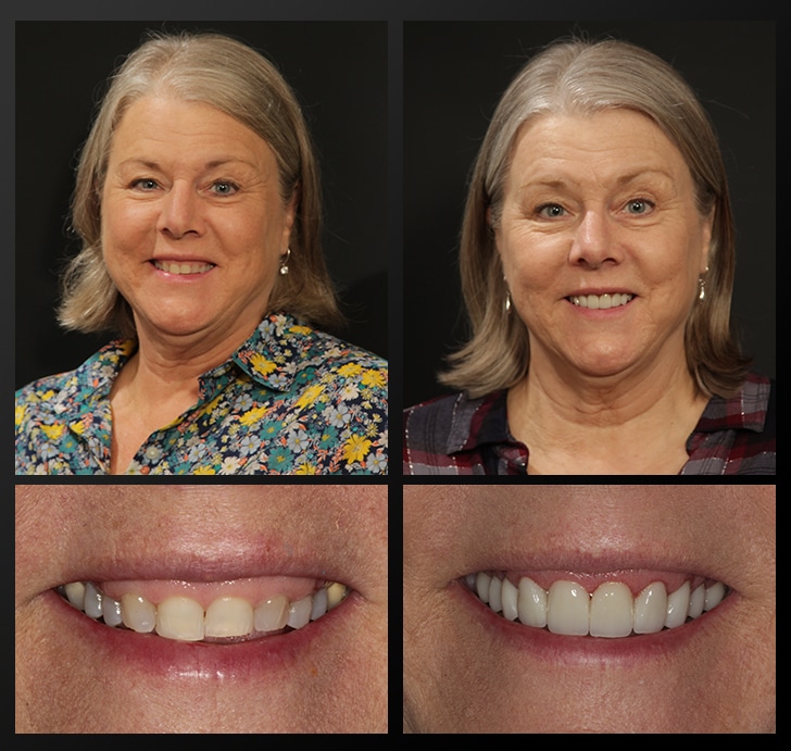 Pam's portrait and smile close up before and after dental treatment lengthens teeth and fixes discoloration