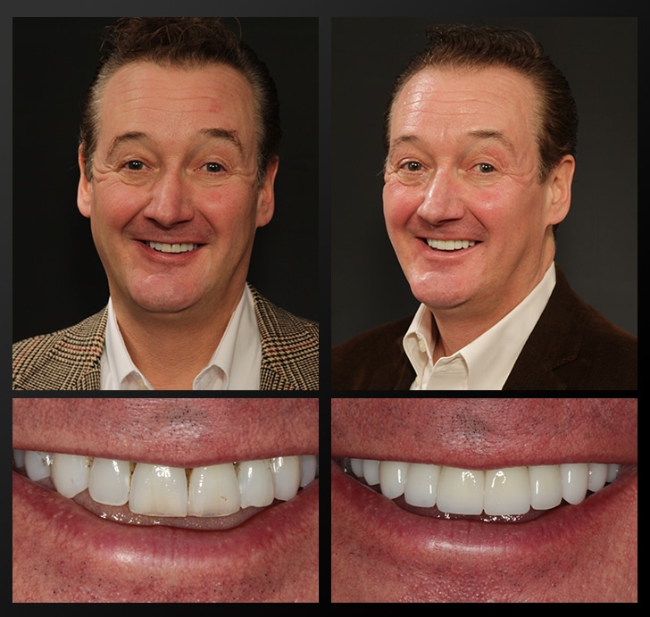 Tom's portrait and smile close up before and after dental treatment fixes gaps and discoloration