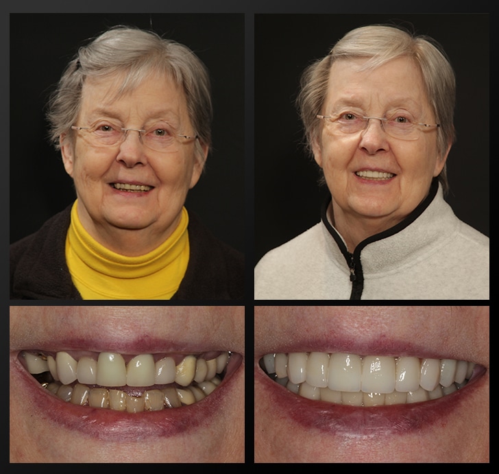 Anna's portrait and smile close up before and after dental treatment fixes uneven and discolored teeth