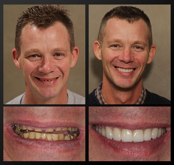 Bob's portrait and smile close up before and after dental treatment fixes broken, gapped, and discolored teeth