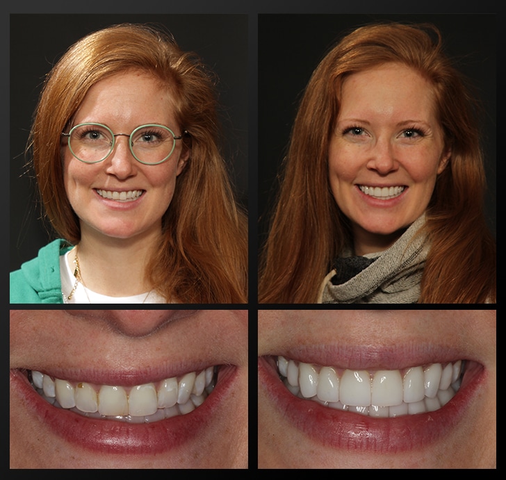 Brooke's portrait and smile close up before and after dental treatment fixes discoloration