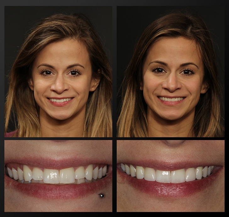 Smile Gallery Template – Haddad Emily Emily's portrait and smile close up before and after dental treatment whitens and evens teeth
