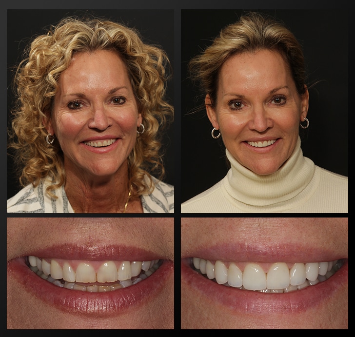 Lori's portrait and smile close up before and after dental treatment fixes discoloration and length of teeth