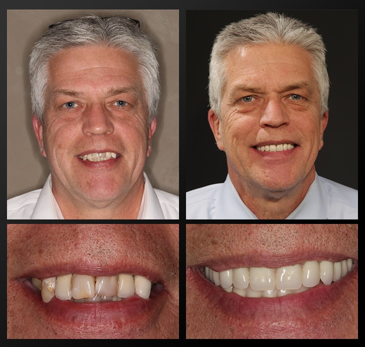 Mark's portrait and smile close up before and after dental treatment fixed his overbite and discoloration