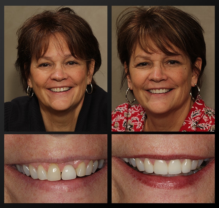 Barb's portrait and smile close up before and after dental treatment fixes discoloration and uneven teeth