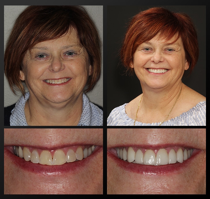 Deb's portrait and smile close up before and after dental treatment