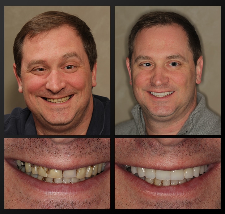 Jeff's portrait and smile close up before and after dental treatment