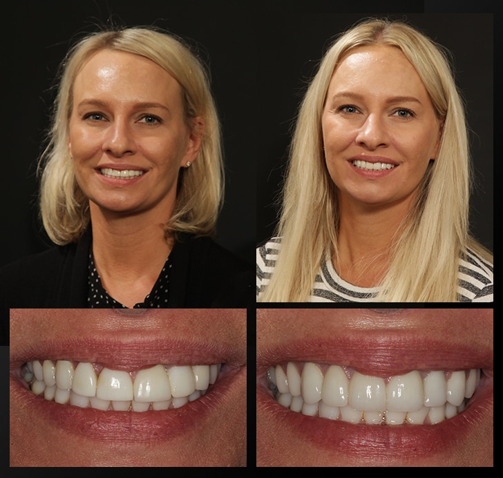 Jessica's portrait and smile close up before and after dental treatment