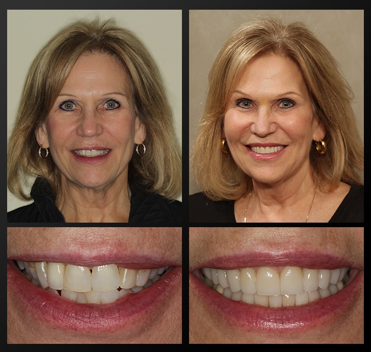 Sandie's portrait and smile close up before and after dental treatment fixes gaps and crookedness