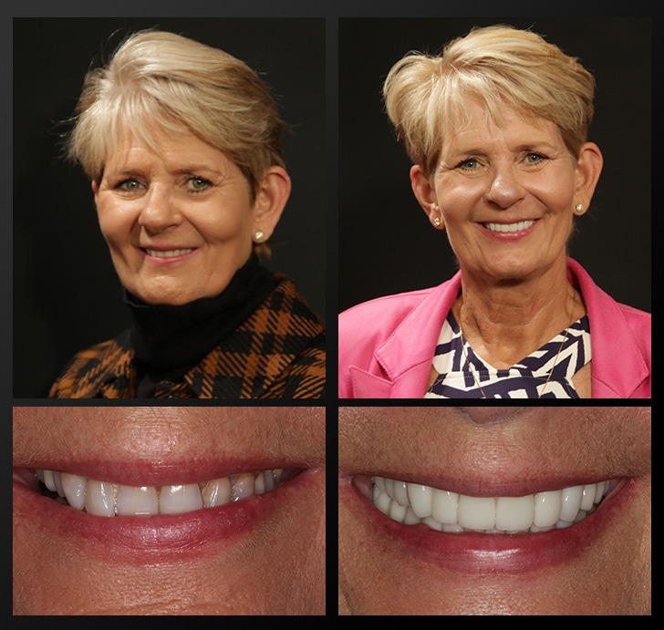 Ann's portrait and smile close up before and after dental treatment