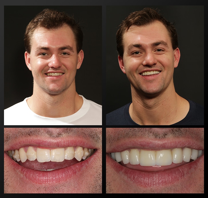 Grant's portrait and smile close up before and after dental treatment