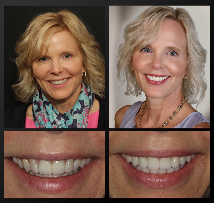 Heather's portrait and smile close up before and after dental treatment