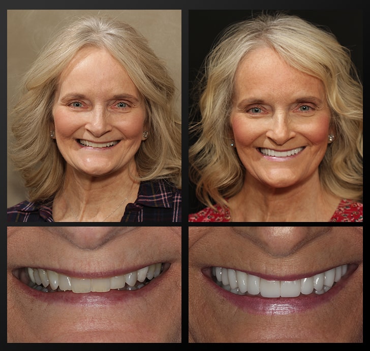 Judy's portrait and close up of her smile before and after dental treatment