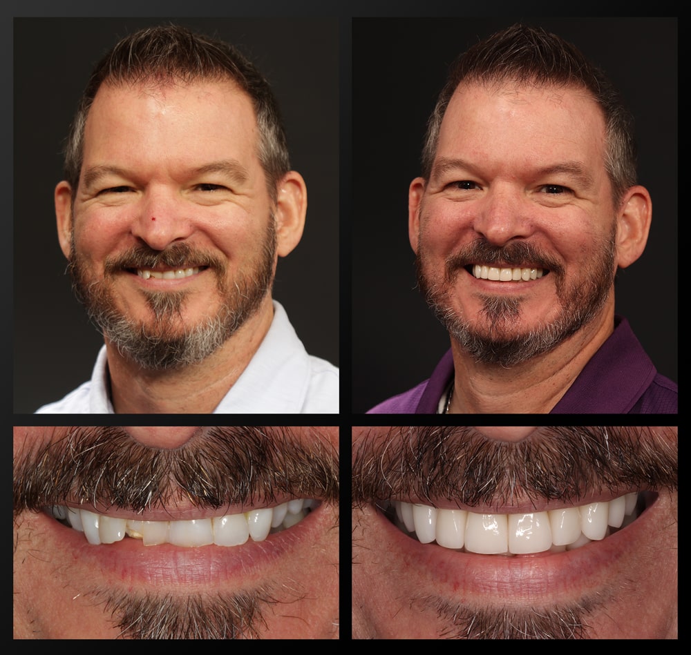 smile gallery patient before and after