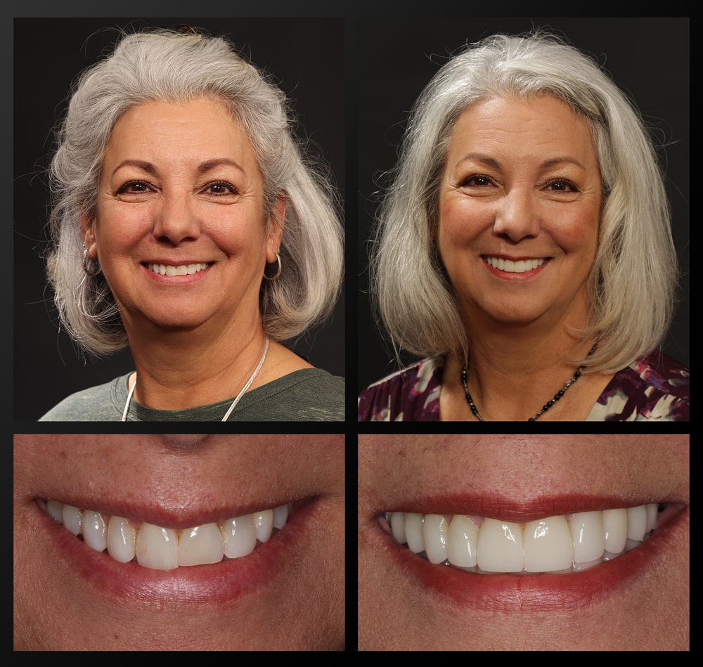 smile gallery patient before and after