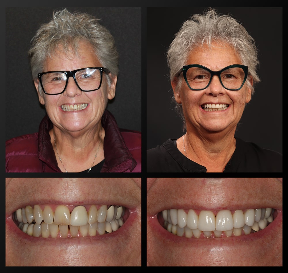 Patient-Before-and-After-Sandra smile gallery patient before and after