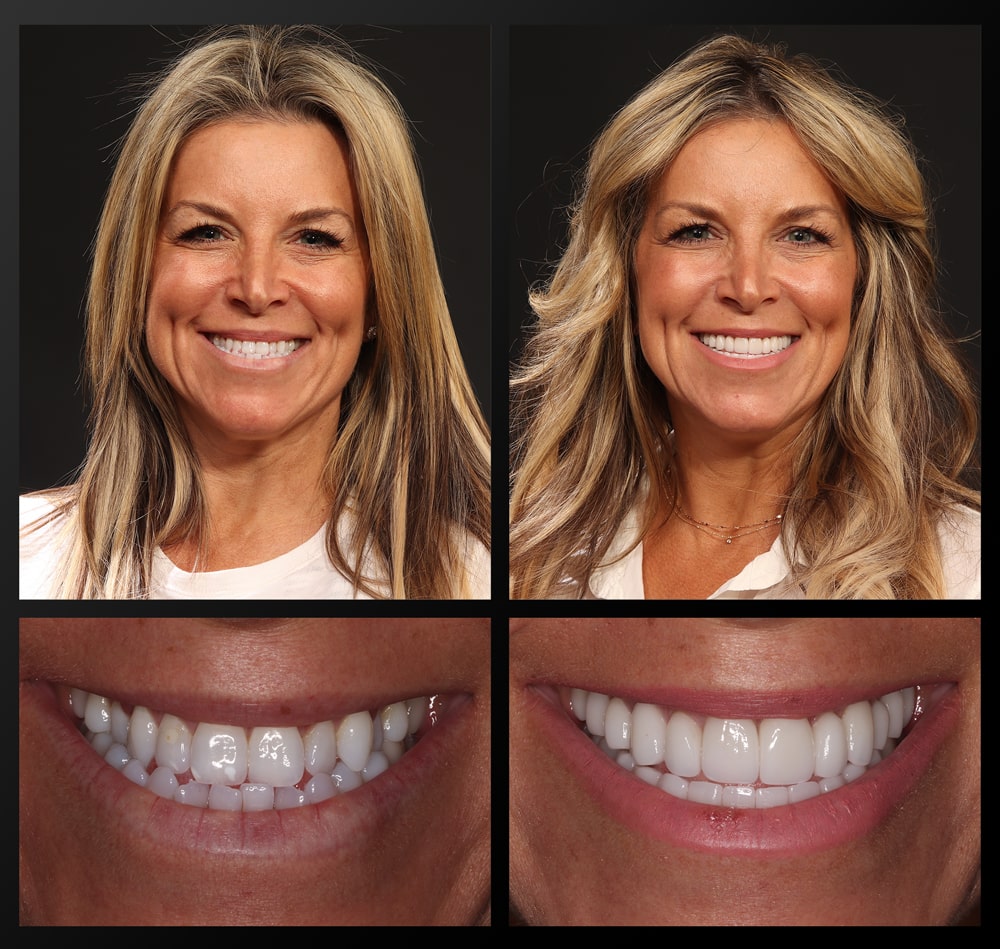 smile gallery patient before and after