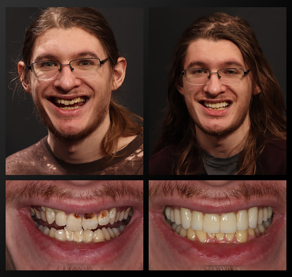 Haddad-Patient-Before-and-After-Nate