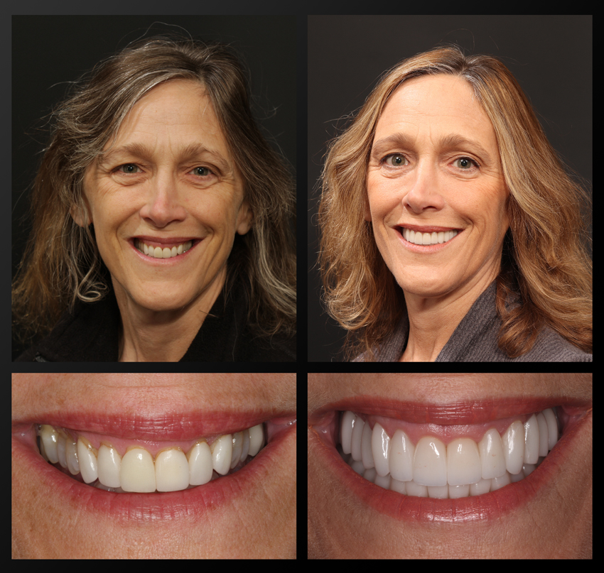 TMJ patient, before and after treatment