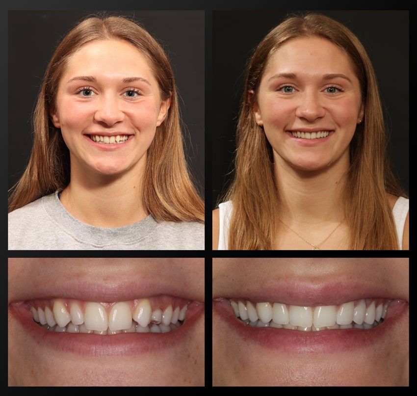 Chloe-Haddad-Patient-Before-and-After-min patient before and after collage