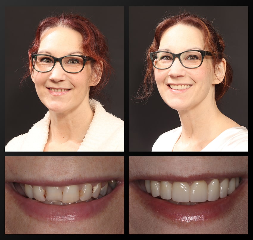 Amy - Haddad Patient before and after