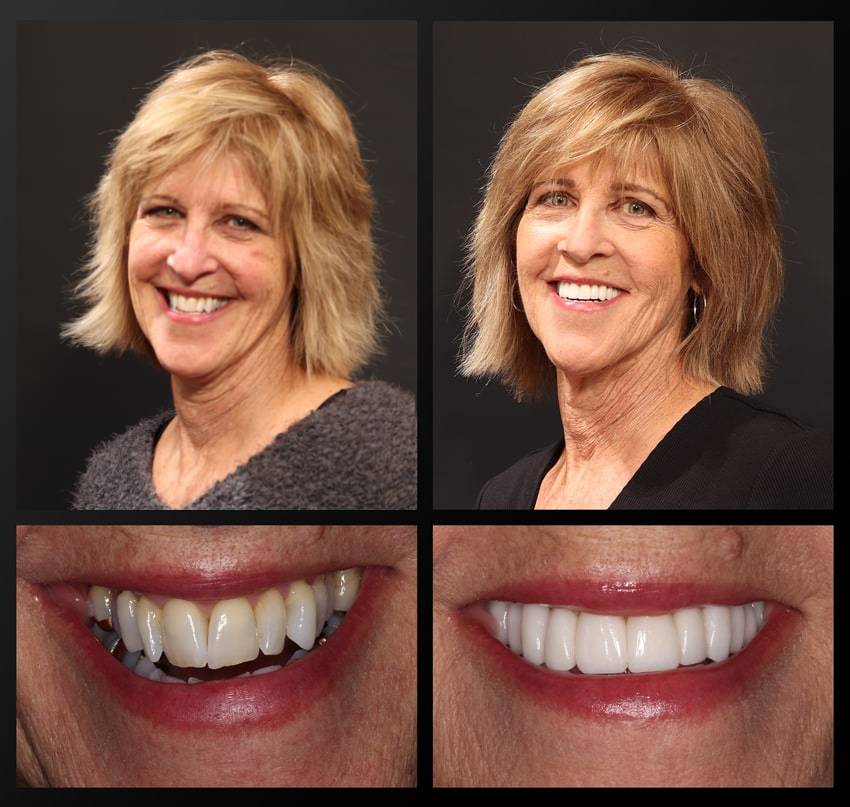 Jean before and after treatment.