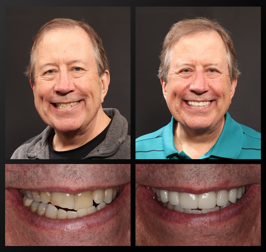 John - Haddad Patient before and after