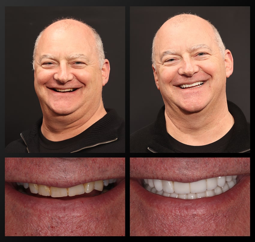 Michael - Haddad Patient before and after