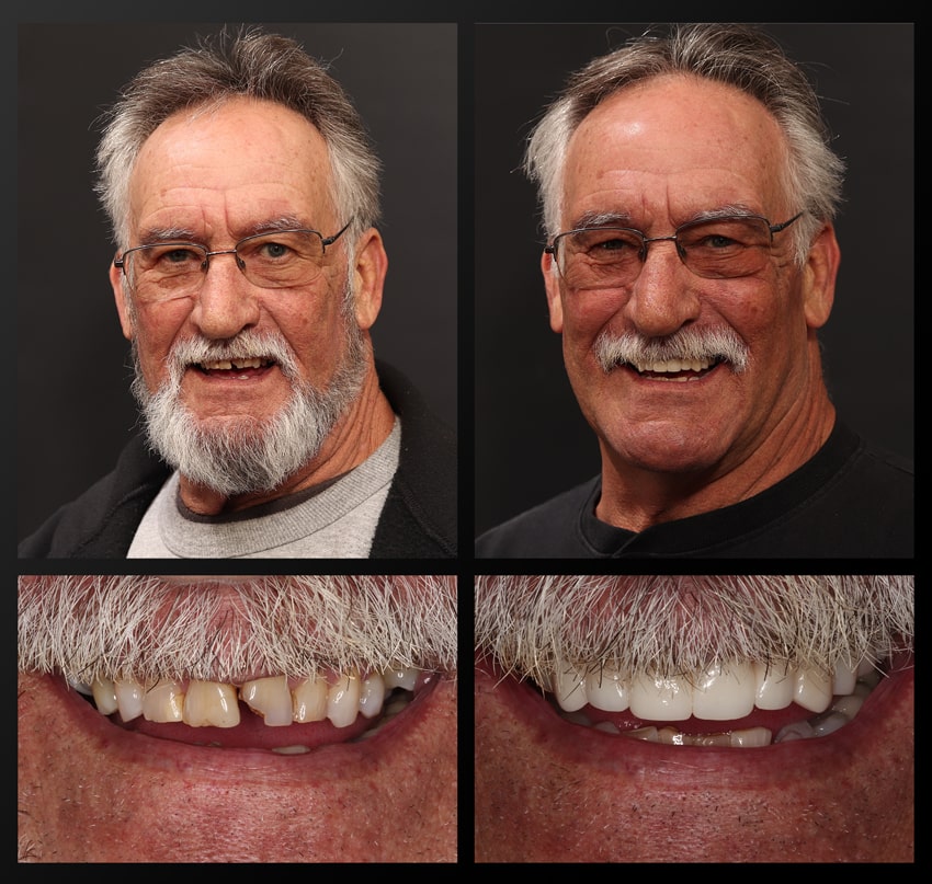 Steve - Haddad Patient before and after