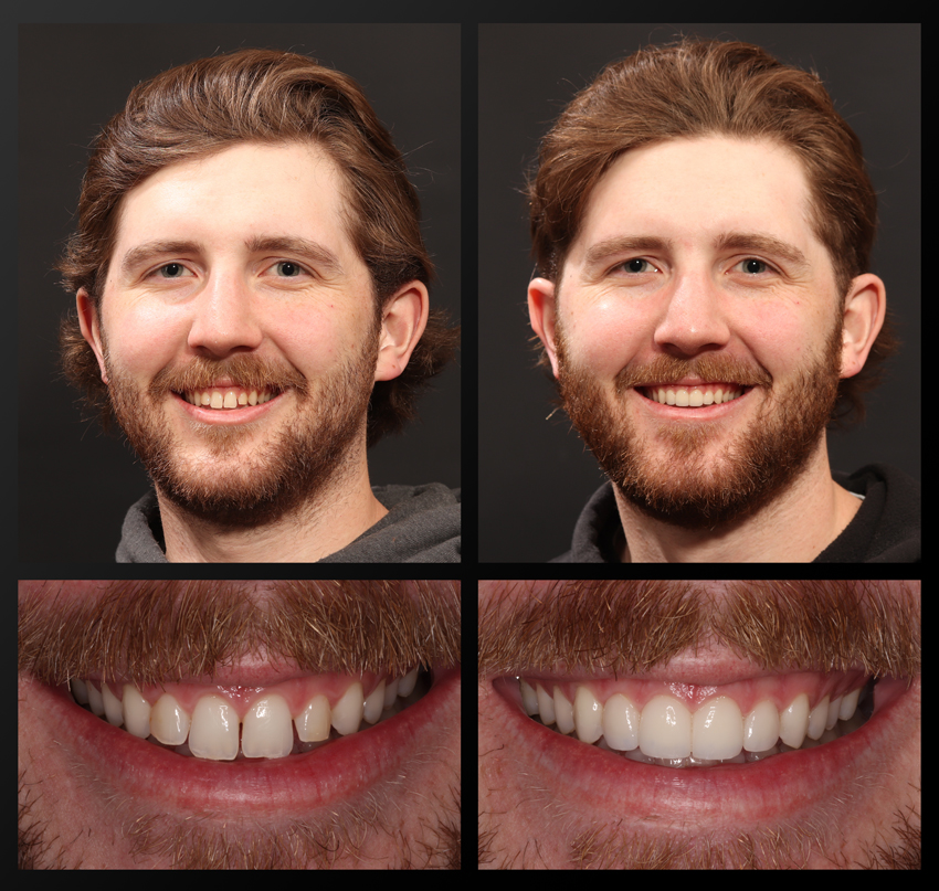 Sammy - Haddad Patient before and after