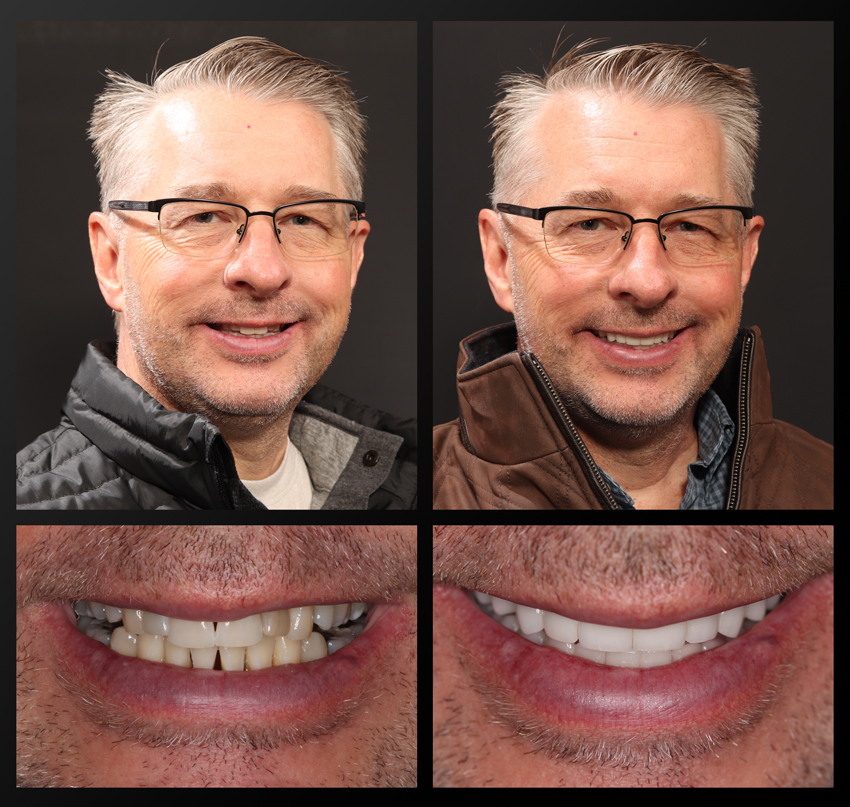 Tom - Haddad Patient before and after