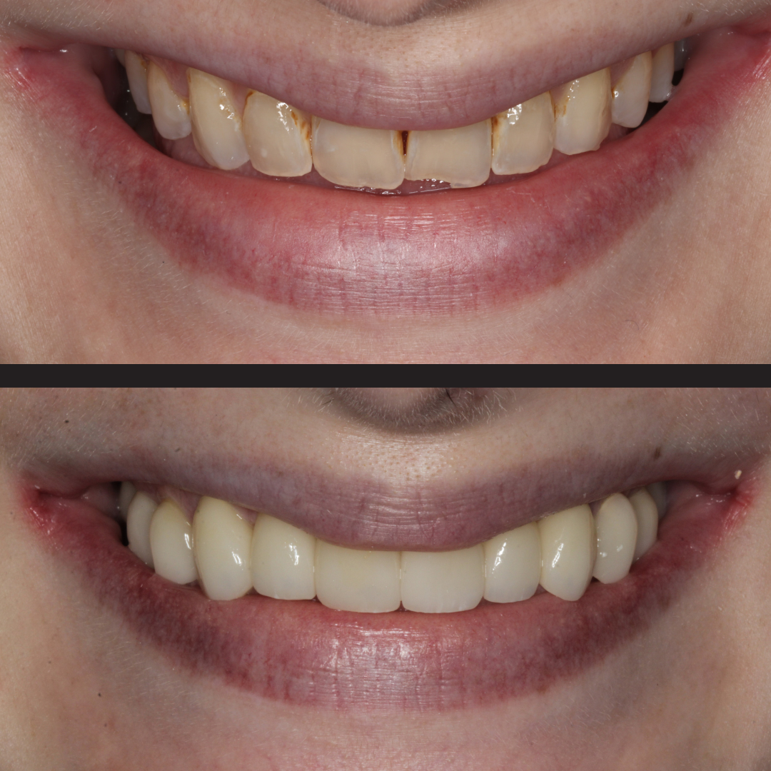 Before-and-after dental makeover: chipped, stained teeth on top; restored, white veneers on bottom smile edge.